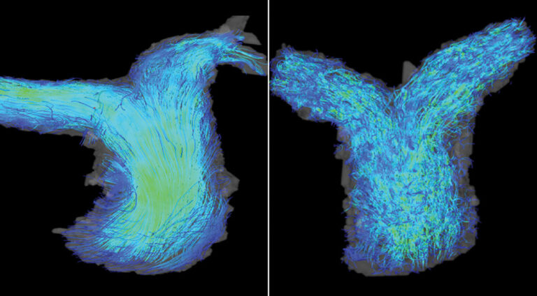 Debilitating and rising form of heart failure is target of new multi-modal study