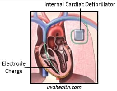 cardiac defibrillator