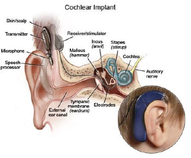 Cochlear Implant Morgridge Institute For Research